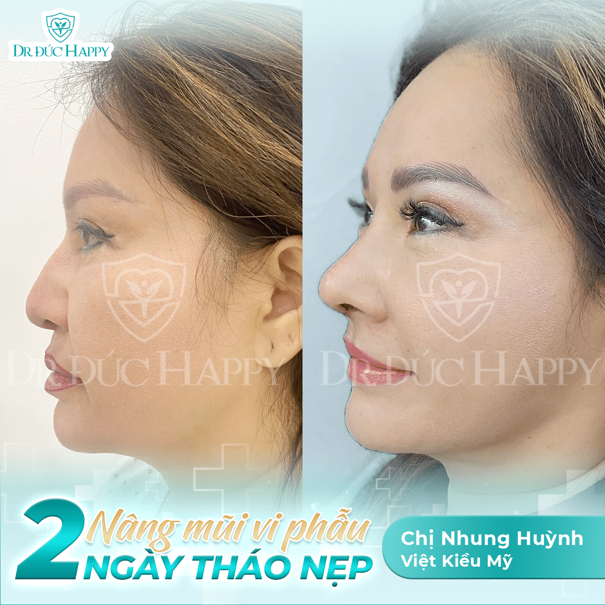 Khách Việt kiều Nhung Huỳnh sau nâng sửa mũi tại Dr. Đức Happy