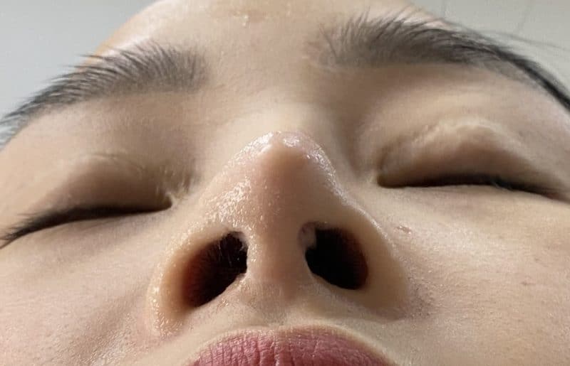 Mũi sụn sườn bị lộ sụn có nguy hiểm không?